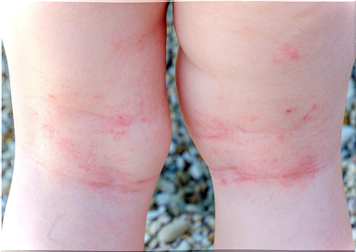 10 questions about atopic dermatitis