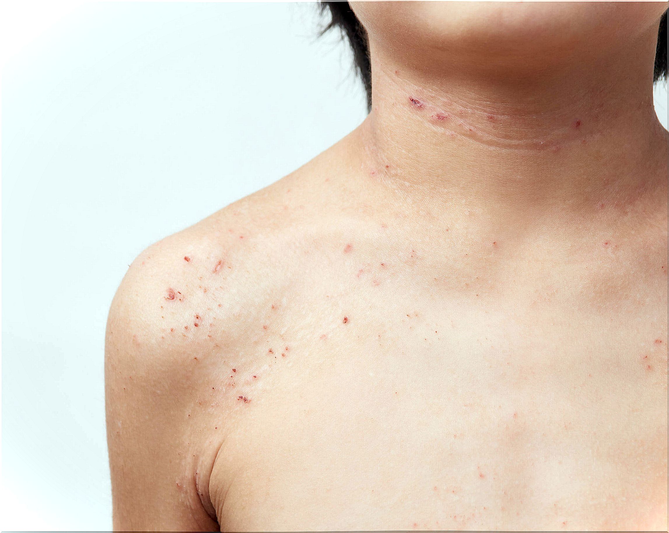 Child with atopic dermatitis.