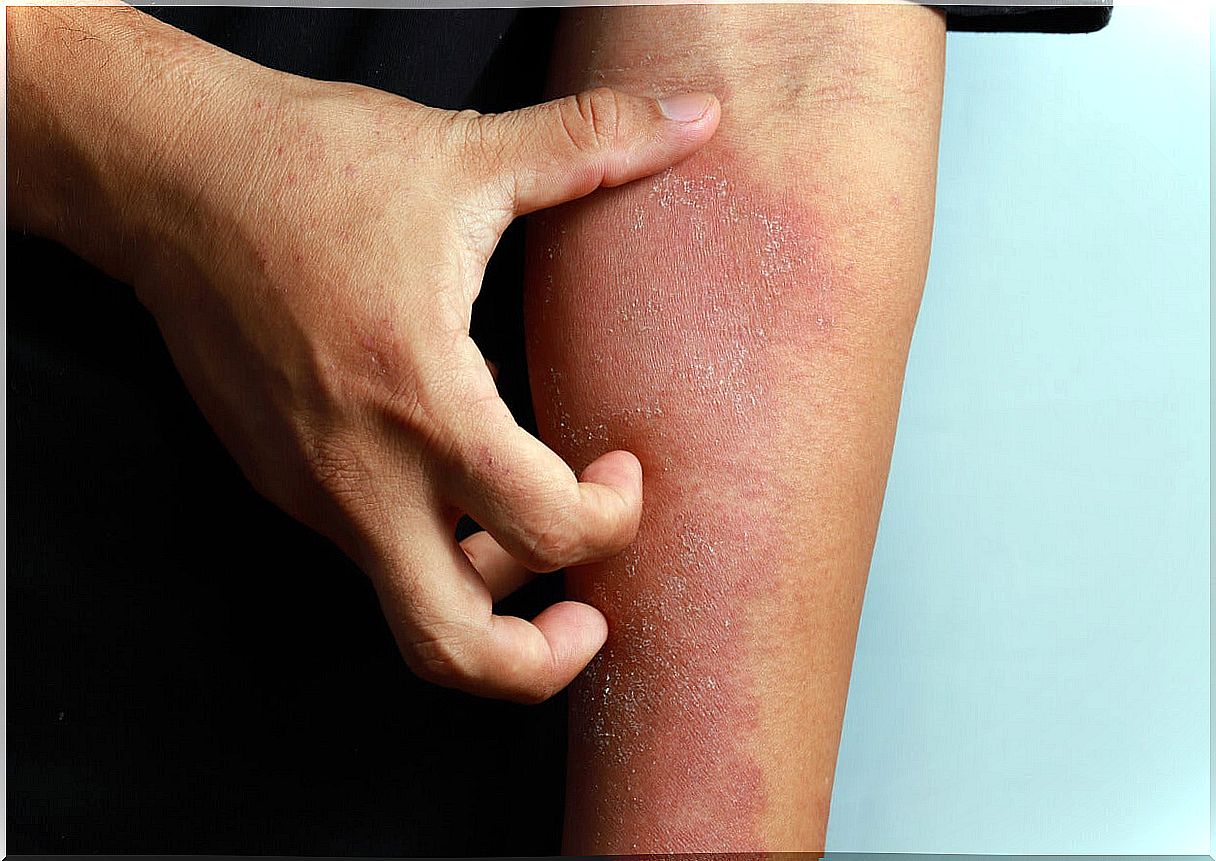 Arm of a man with eczema from atopic dermatitis.