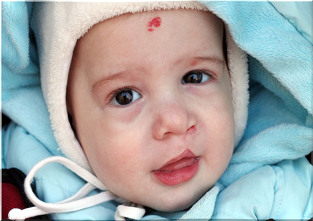 Child with a cleft lip.