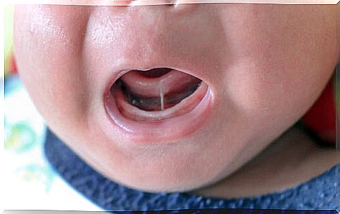 Ankyloglossia or short lingual frenulum in children