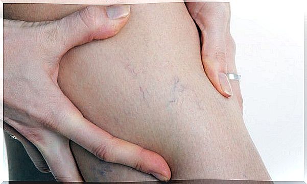 Eliminate varicose veins during pregnancy by doing, among other things, exercises that improve circulation.