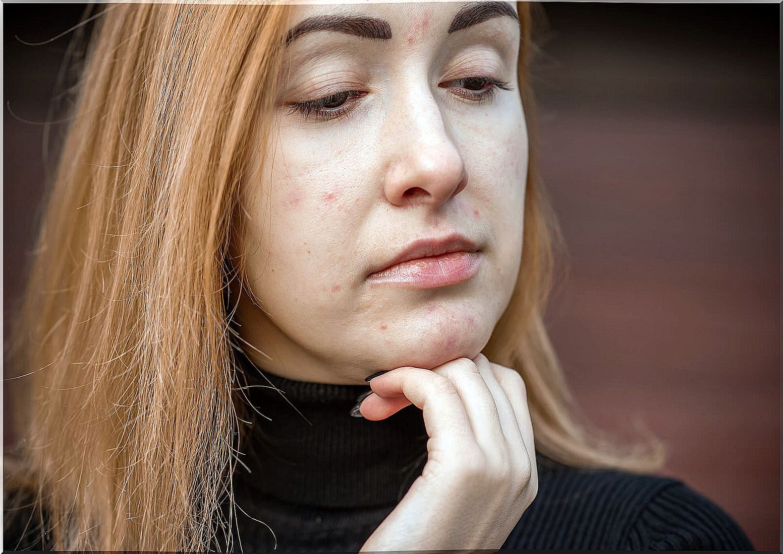 Girl with juvenile acne.