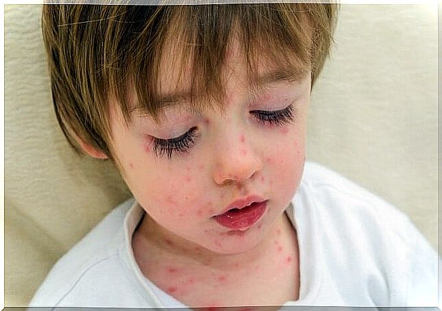 What to do if my child has chickenpox?